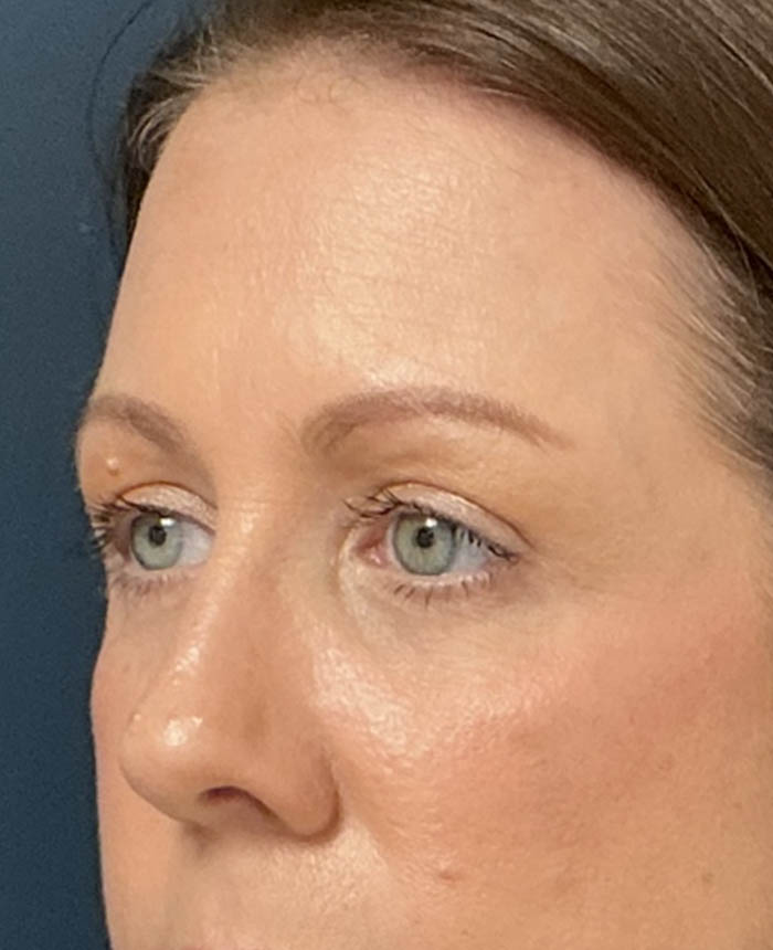 Eyelid Surgery case #16677