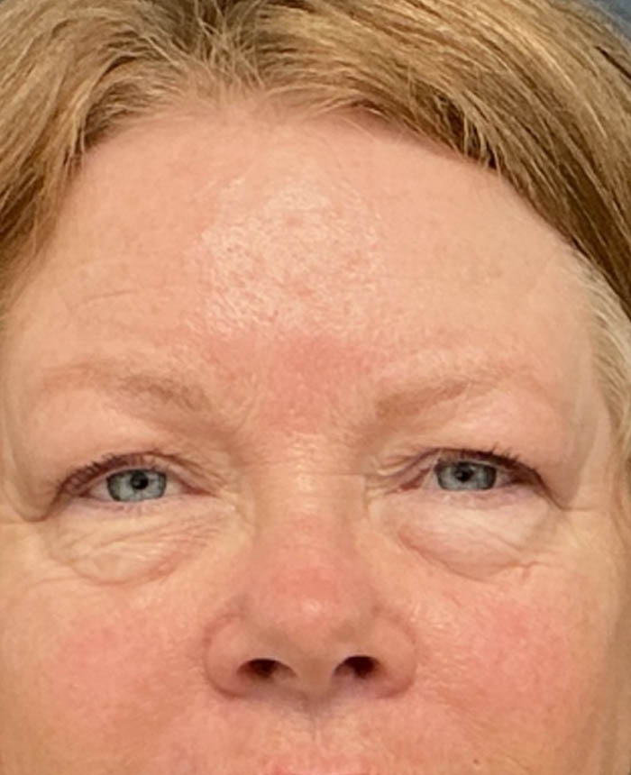 Eyelid Surgery case #16672