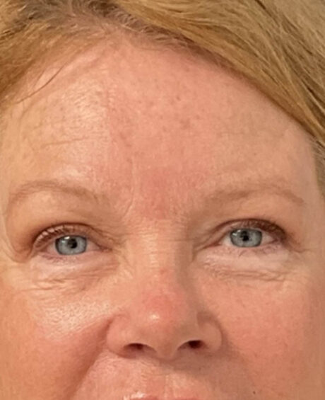 Eyelid Surgery case #16672