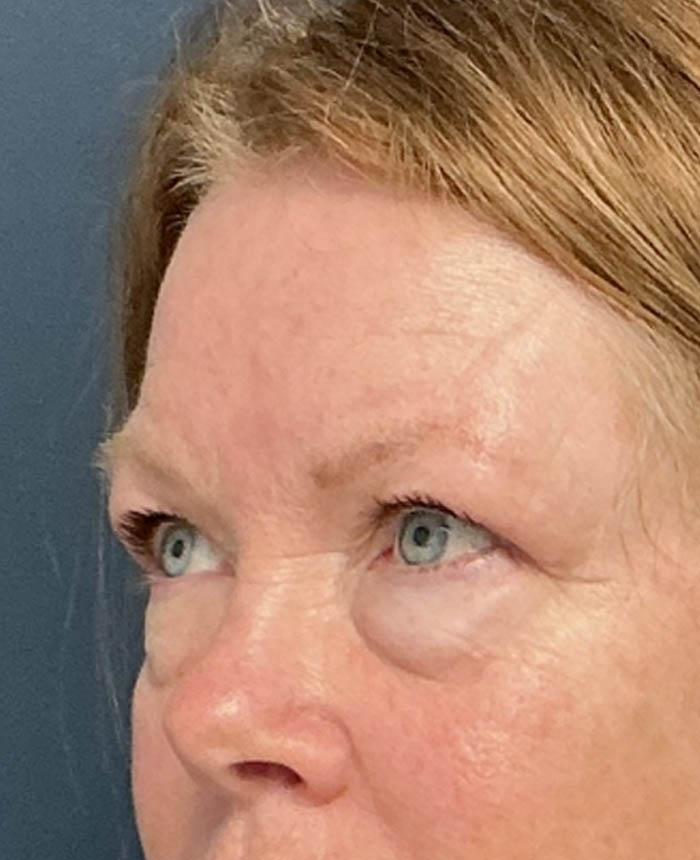 Eyelid Surgery case #16672