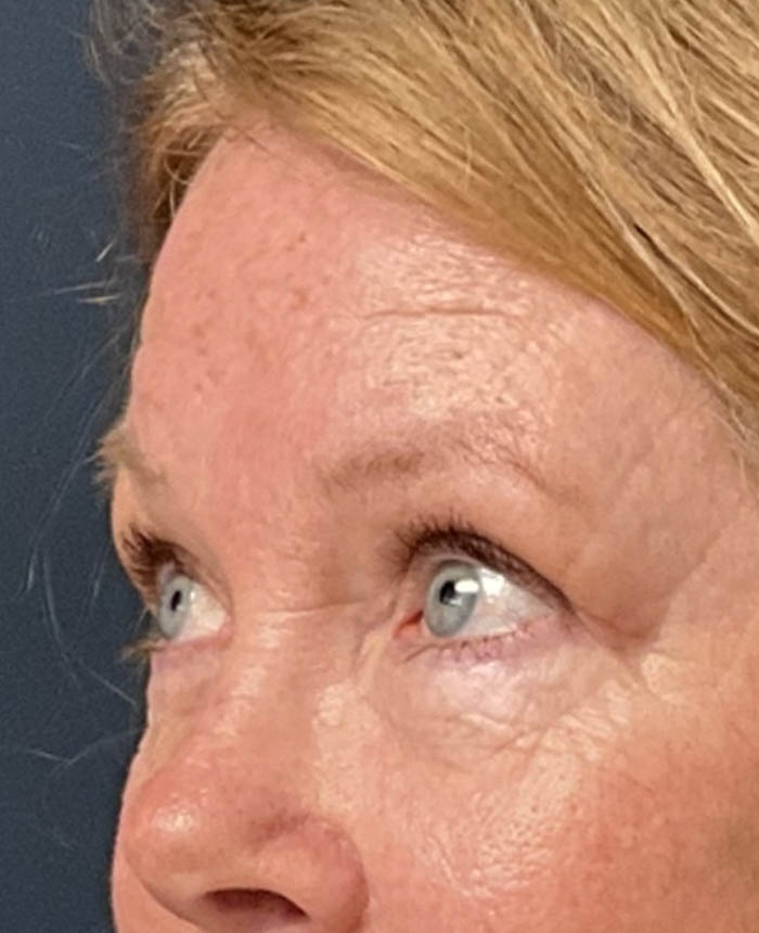 Eyelid Surgery case #16672