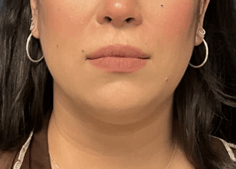 Chin Liposuction case #16667