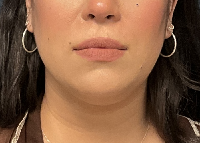 Chin Liposuction case #16667
