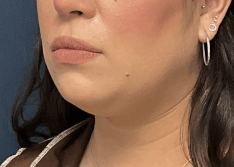 Chin Liposuction case #16667