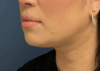 Chin Liposuction case #16667