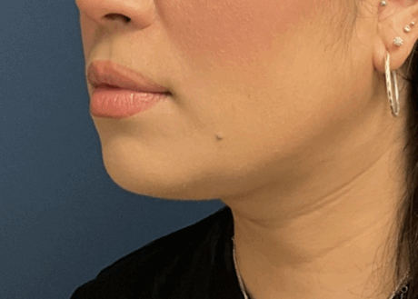 Chin Liposuction case #16667