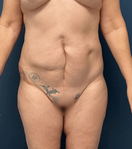 Tummy Tuck case #17240