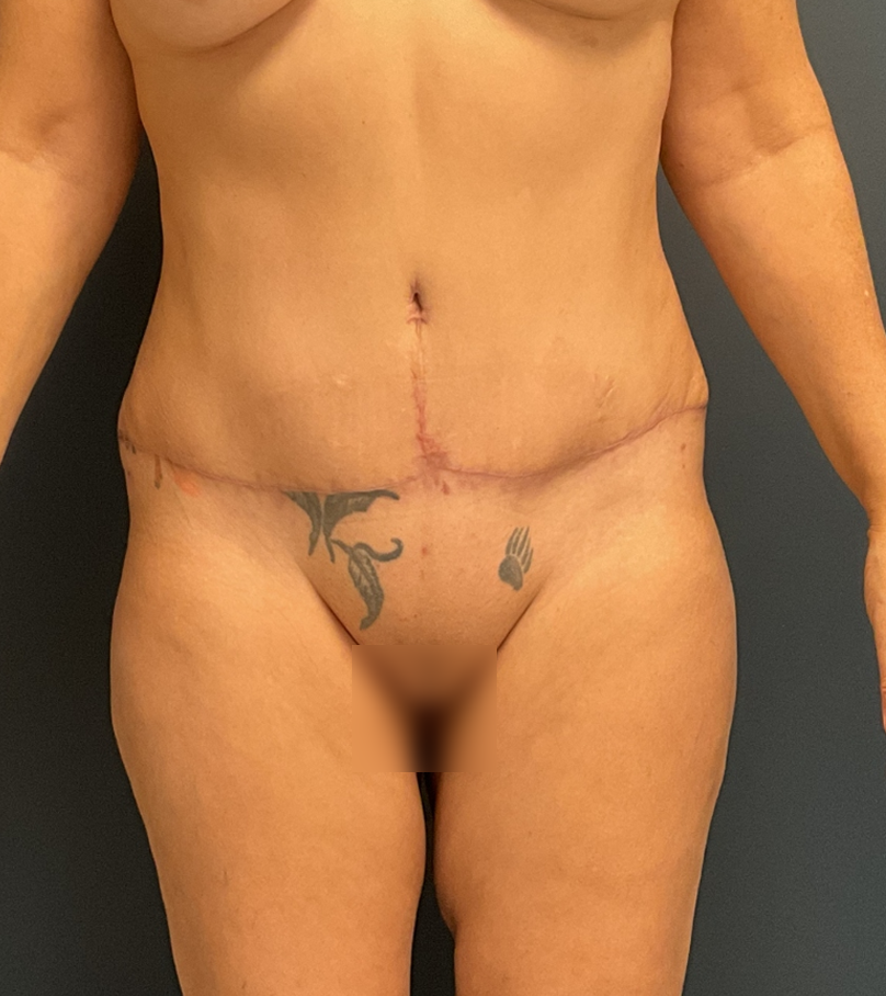 Tummy Tuck case #17240