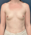 Breast Augmentation case #17273
