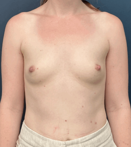 Breast Augmentation case #17273