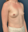 Breast Augmentation case #17273