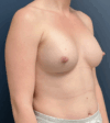 Breast Augmentation case #17273