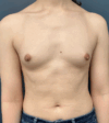 Breast Augmentation case #17278