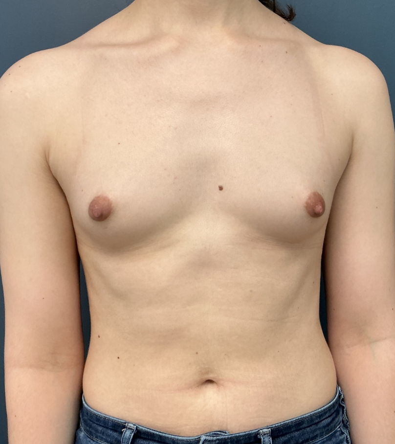 Breast Augmentation case #17278