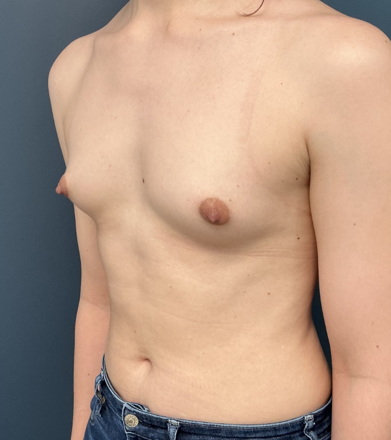 Breast Augmentation case #17278