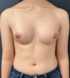 Breast Augmentation case #17278