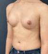Breast Augmentation case #17278