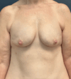 Breast Augmentation case #17286
