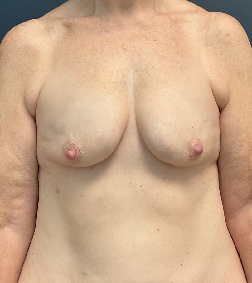 Breast Augmentation case #17286