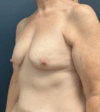 Breast Augmentation case #17286