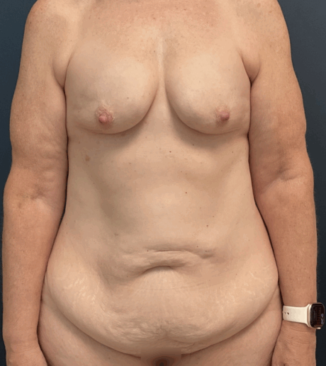 Tummy Tuck case #17254