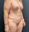 Tummy Tuck case #17254