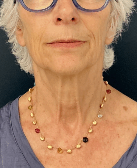 Facelift case #17302