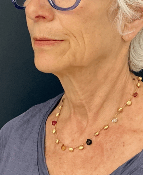 Facelift case #17302