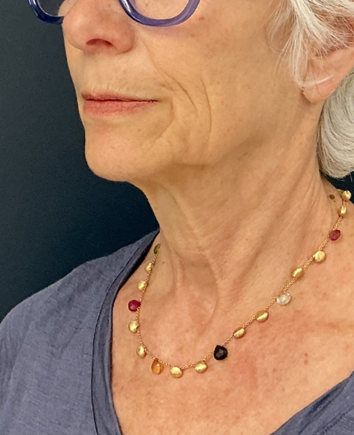 Facelift case #17302