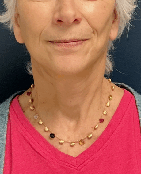 Facelift case #17302