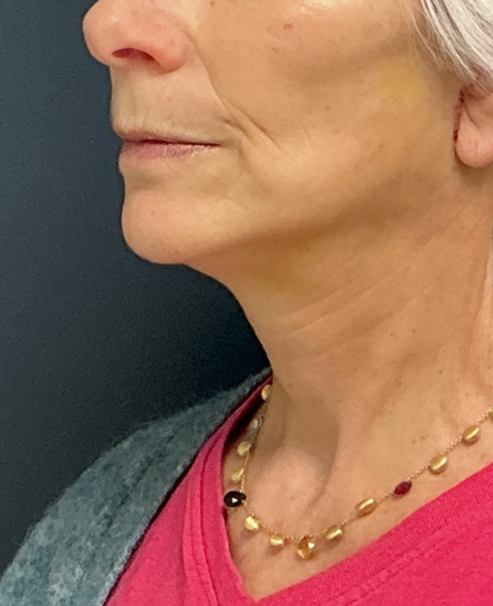 Facelift case #17302