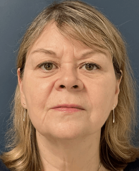 Facelift case #17307