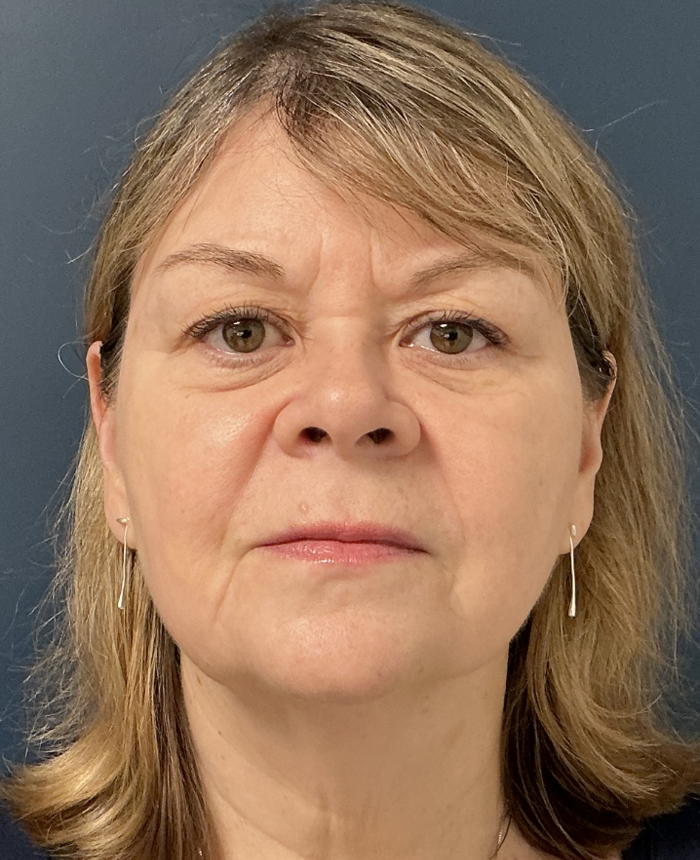 Facelift case #17307