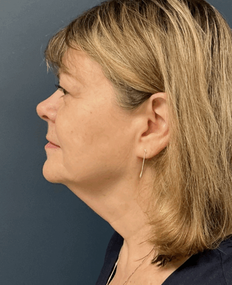 Facelift case #17307