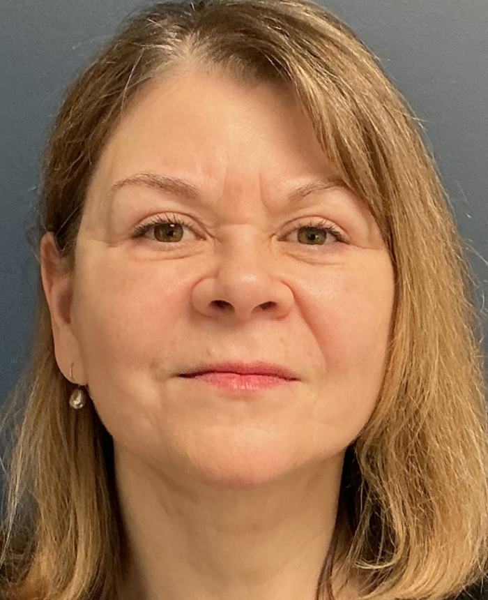 Facelift case #17307