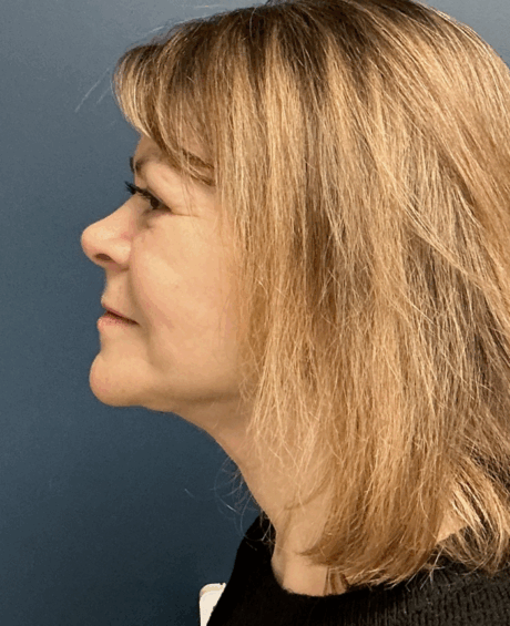 Facelift case #17307