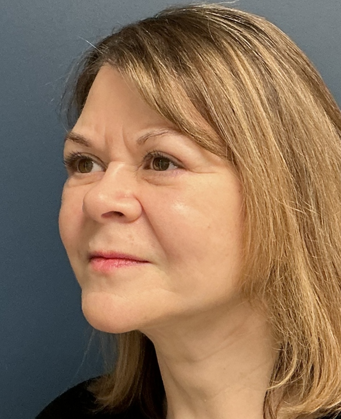 Facelift case #17307