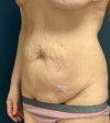 Tummy Tuck case #17235