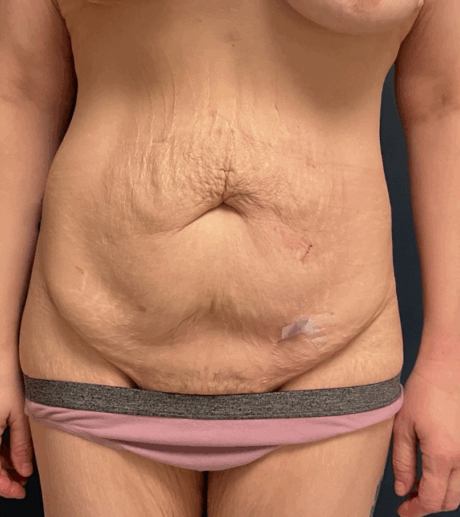 Tummy Tuck case #17235