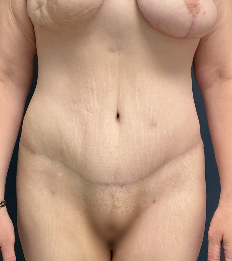 Tummy Tuck case #17235