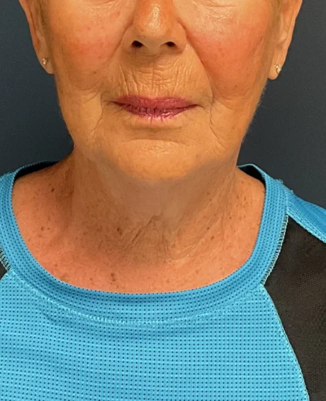 Facelift case #18828