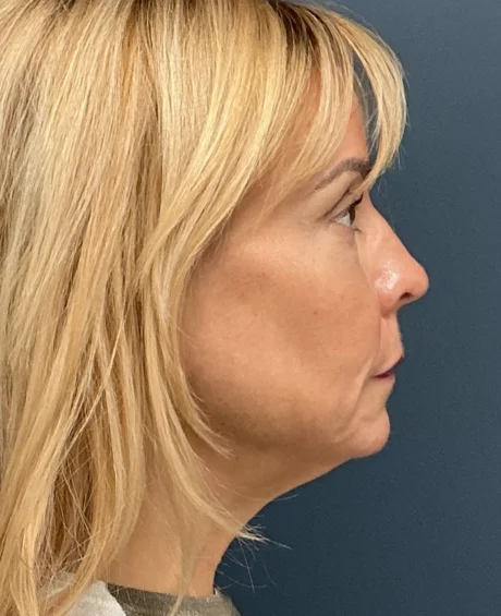 Eyelid Surgery case #18829