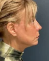 Eyelid Surgery case #18829