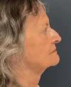 Facelift case #18830