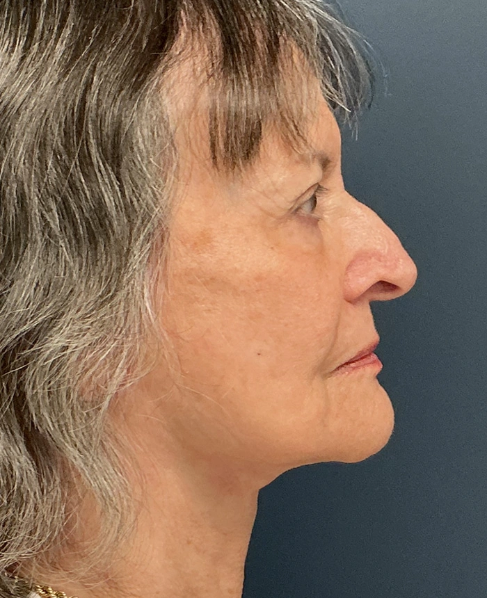Facelift case #18830