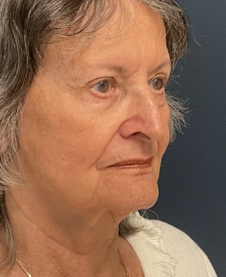Facelift case #18830