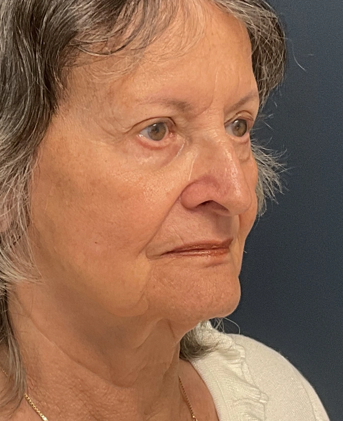 Facelift case #18830