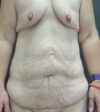 After Weight Loss case #19080