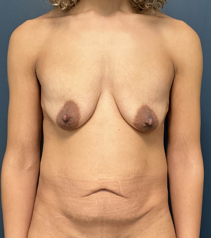 Breast Augmentation With Lift case #18757