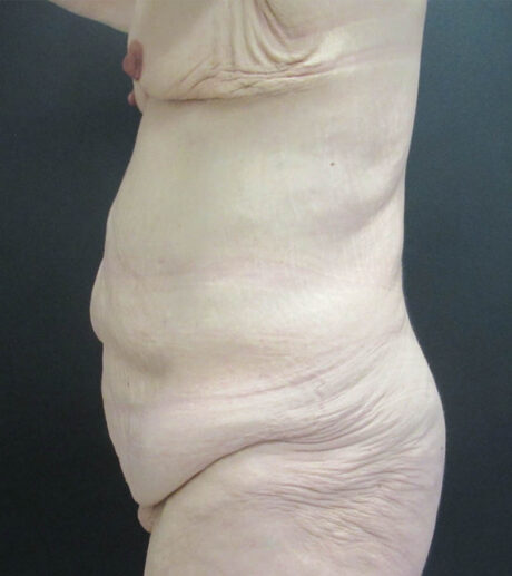 After Weight Loss case #19080